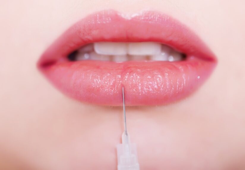 Lip Fillers in Toms River