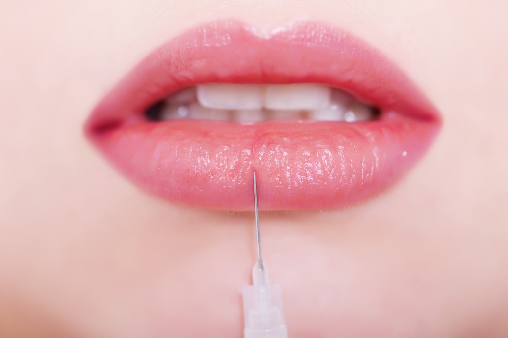 Lip Fillers in Toms River