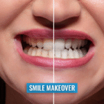 Smile Makeover