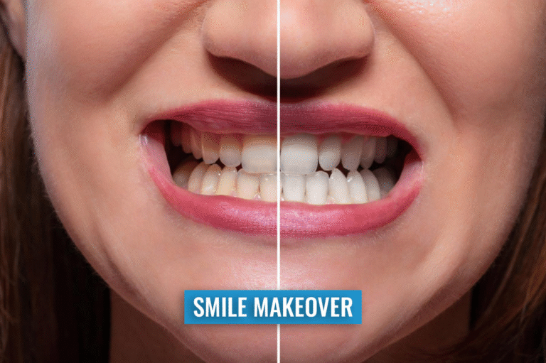 Smile Makeover