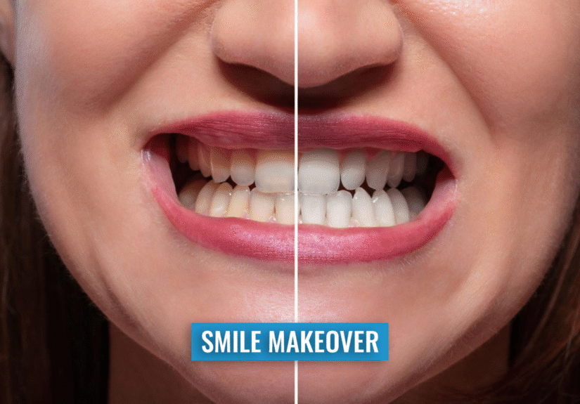Smile Makeover
