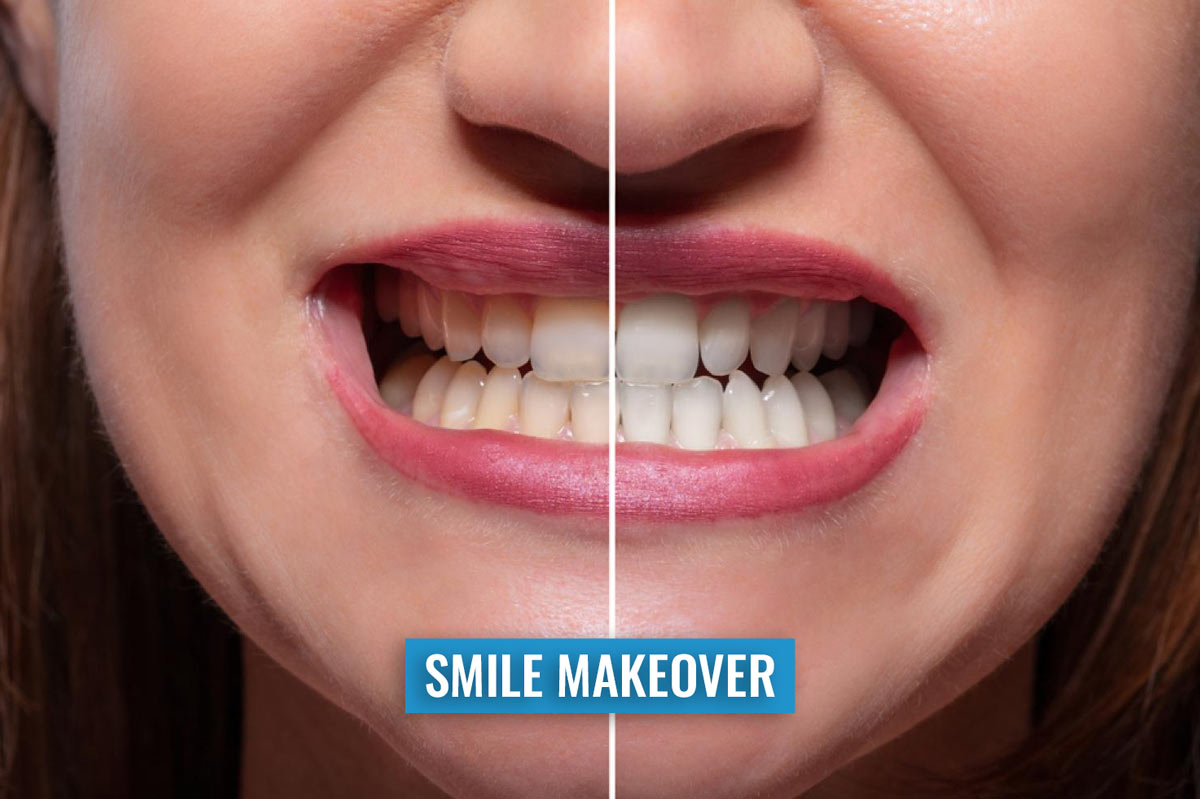 Smile Makeover