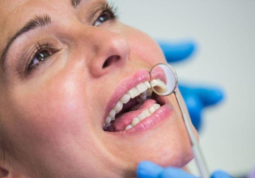 Dental Fillings