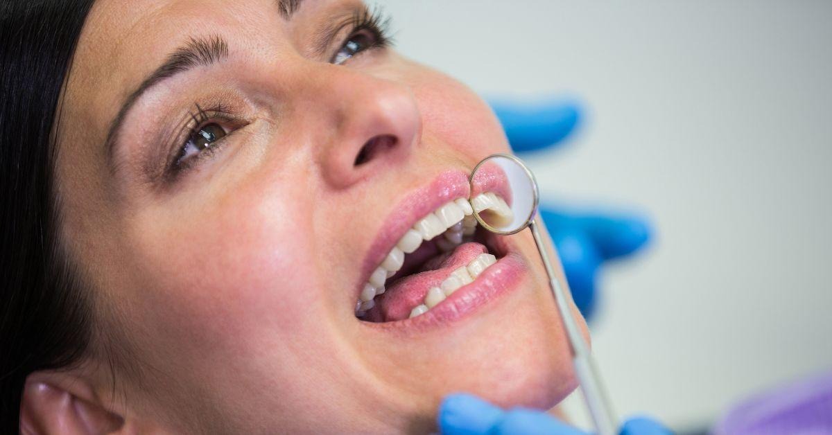 Dental Fillings